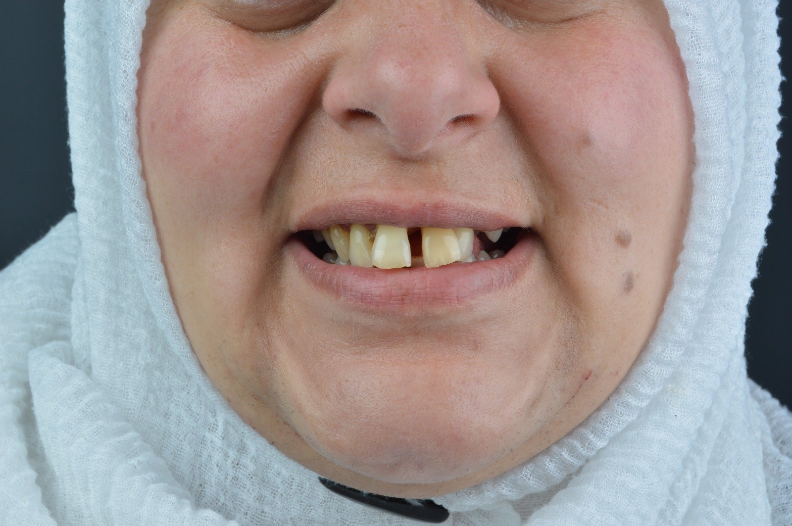 Zirkonyum Kaplama - 1 Öncesi