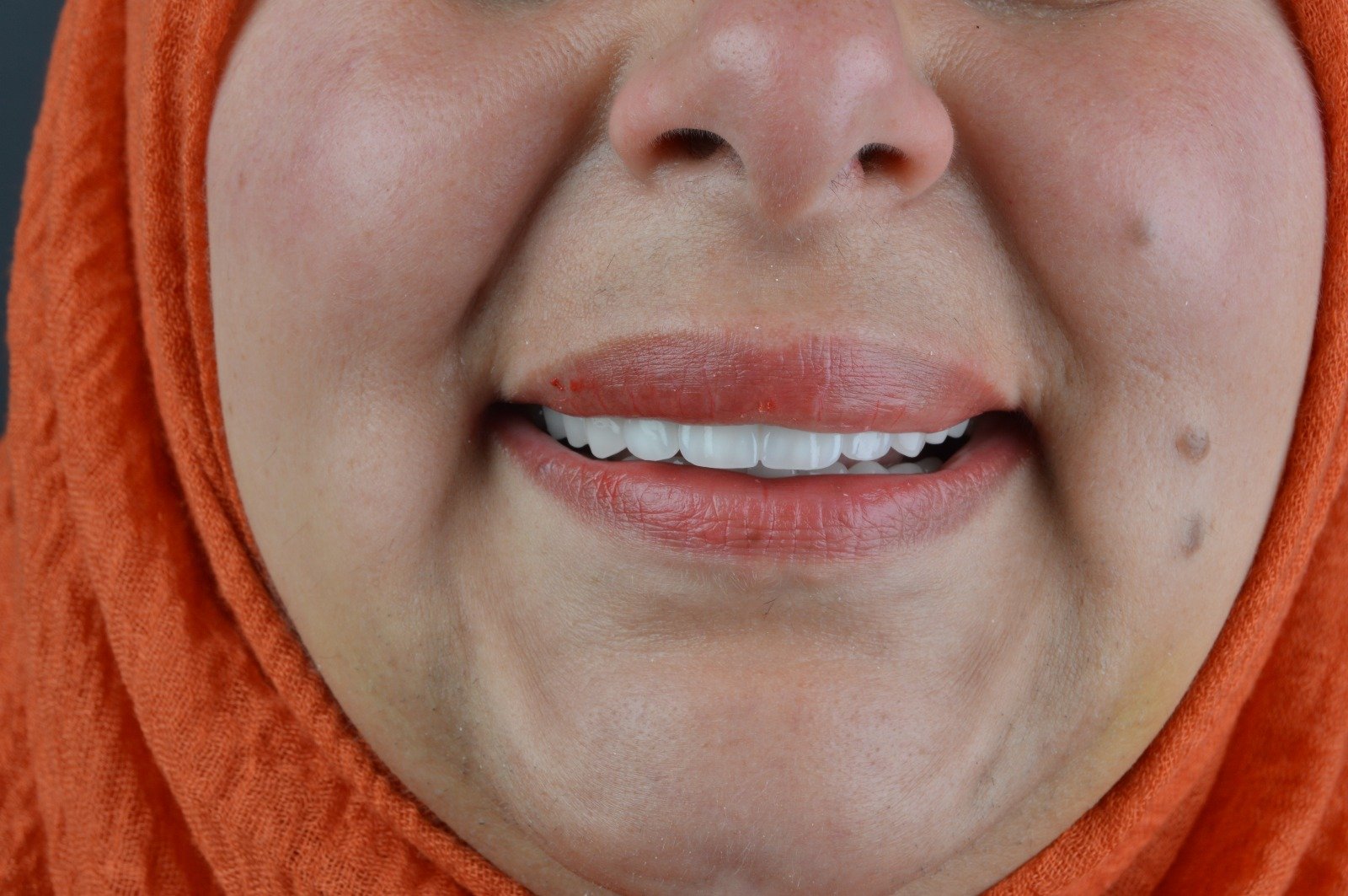 Zirkonyum Kaplama - 1 Sonrası